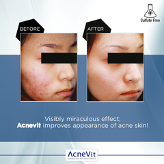 Acnevit Anti-Acne Serum